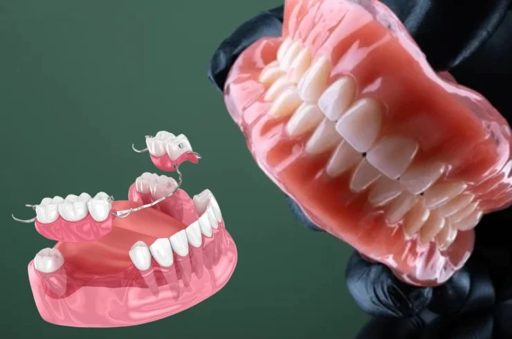 Complete and Partial Dentures