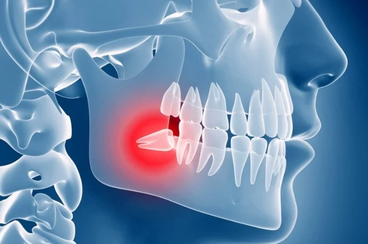 Impaction Removal