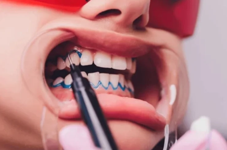 Pola Office Teeth Whitening