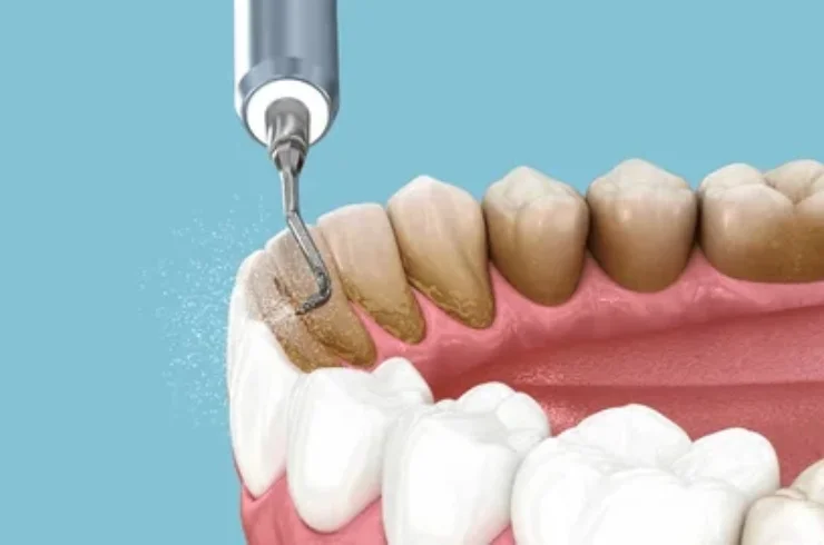 Scaling and Polishing